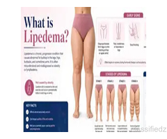 Lipedema Arms: Why It Happens and How It Can Be Treated