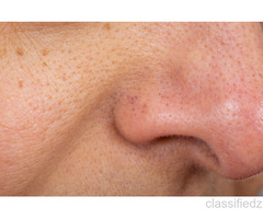 Open Pores Treatment in Noida – Smoother Skin Is Possible