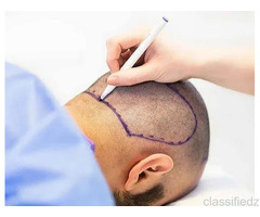 India's Premier Hair Transplant Clinic — Trusted by Thousands!