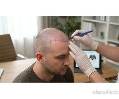 Celebrate Your Curls with Expert Afro Hair Transplant at Dr. Haror's Wellness!