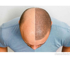 Experienced Hair Fall Doctor in Noida – Personalized Treatment