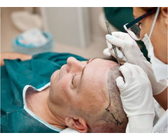 No Need to Break the Bank – Get High-quality Hair Transplant at Affordable Cost