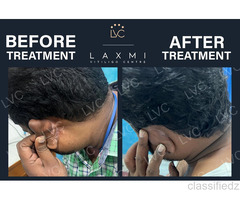 Homeopathic Vitiligo Treatment in Madurai | Laxmi Vitiligo Centre