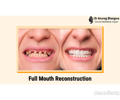 Full Mouth Reconstruction: Restore Your Smile | Dr. Anurag Bhargava